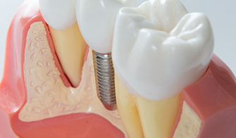 Model of a dental implant with a crown in between two natural teeth